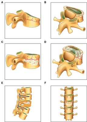 Efficacy of a novel percutaneous pedicle screw fixation and vertebral reconstruction versus the traditional open pedicle screw fixation in the treatment of single-level thoracolumbar fracture without neurologic deficit